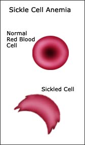 Sickle Cell Anemia